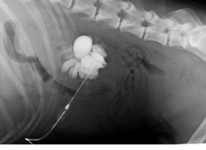 Fig 2 Pielografia antegrada dell’idronefrosi del rene conseguente all ostruzione ureterale