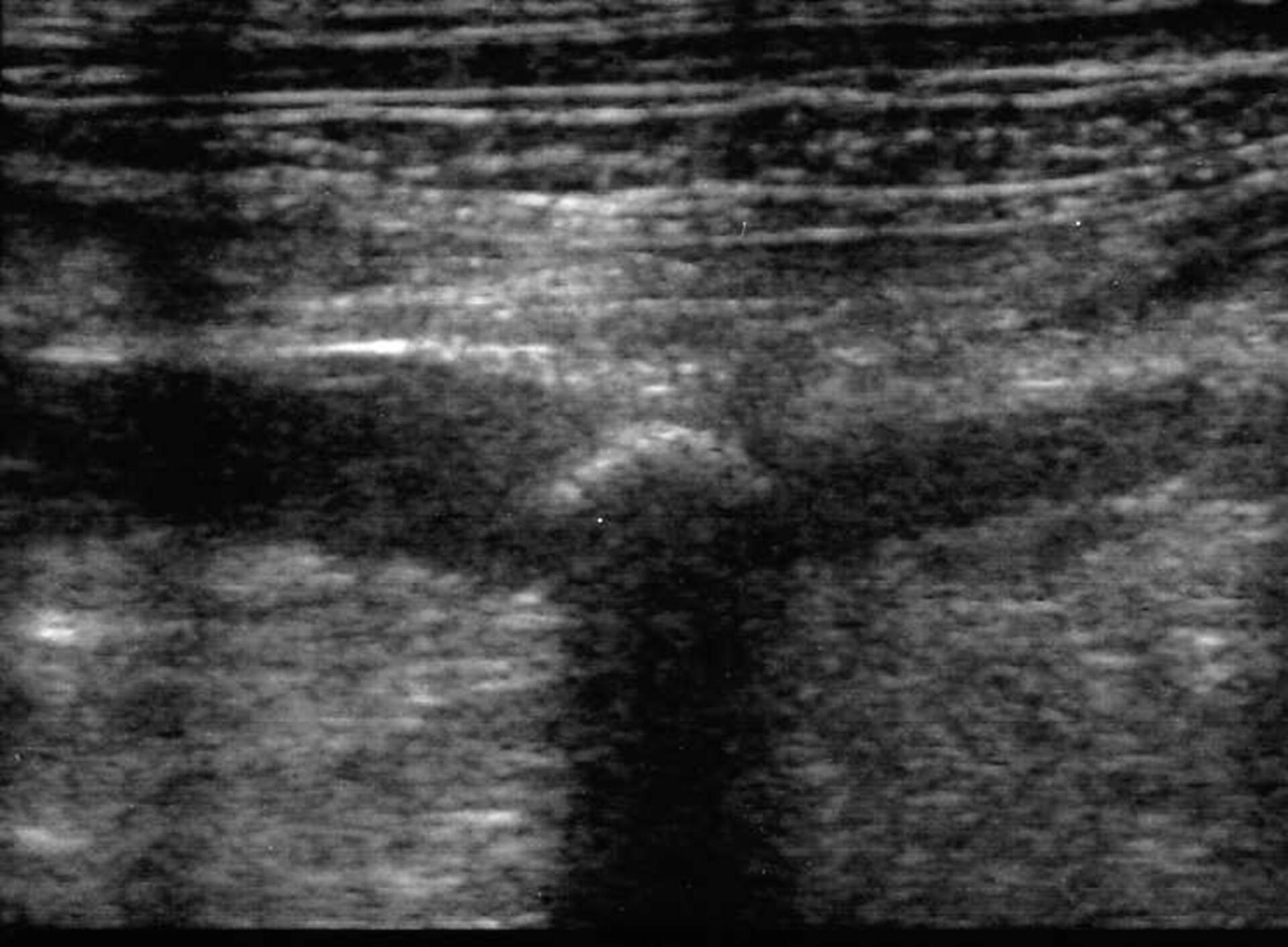 Fig 3 Ostruzione ureterale da calcolo in un cane boxer