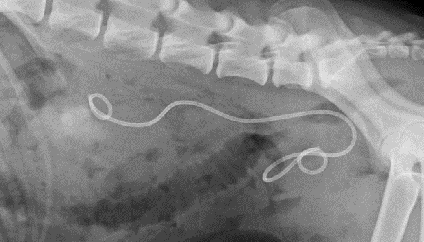 Fig 4 Stent ureterale posizionato nell uretere dopo asportazione chirurgica del calcolo