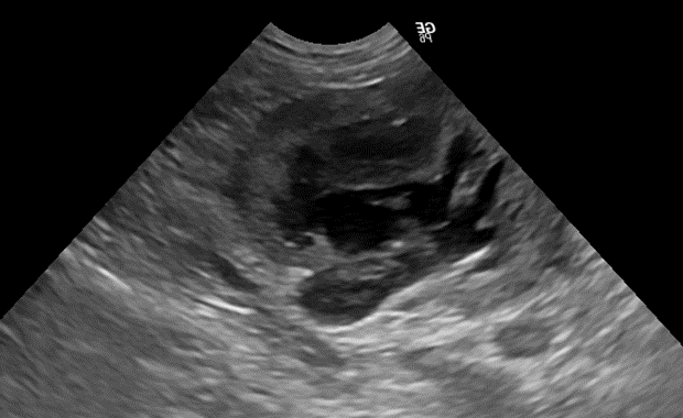 Fig. 5 Idronefrosi monolaterale in un gatto conseguente ad ostruzione ureterale da coaguli di sangue
