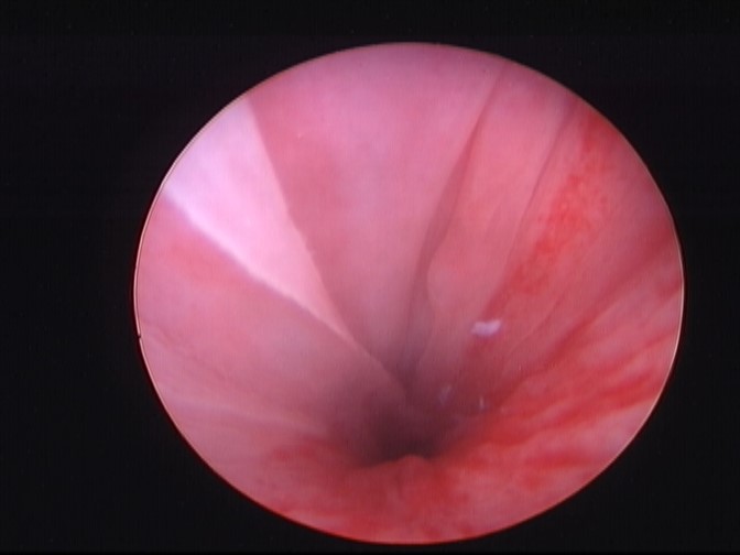 Fig. 9 Cistoscopia apertura di un uretere ectopico (freccia) nella parte dorsale del lume uretrale.