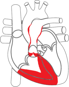 CUORE AFFETTO DA STENOSI POLMONARE