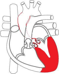 CUORE AFFETTO DA STENOSI AORTICA