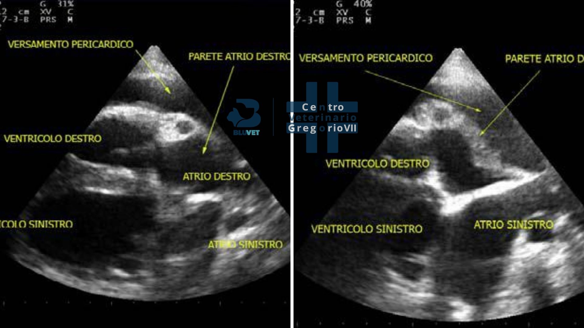 ecografia versamento cardiaco drenato