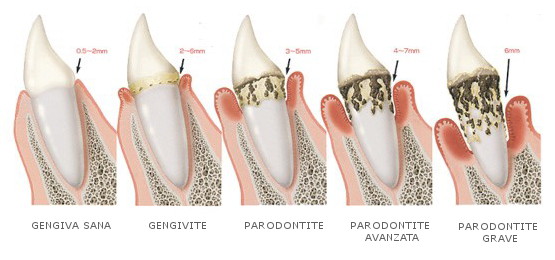 malattia parodontale studio dentistico zamprogno montebelluna