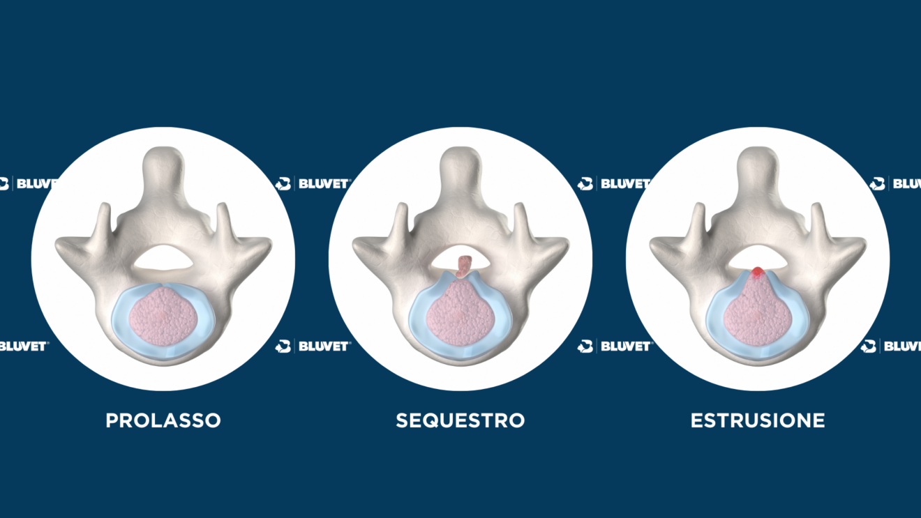 prolasso ed estrusione discale